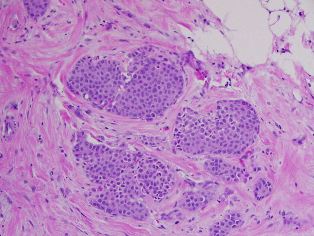 File:Lobular carcinoma in situ.jpg