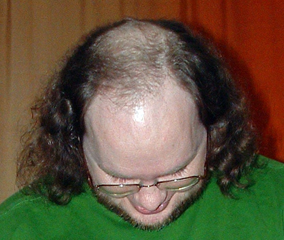 Male pattern baldness.jpg