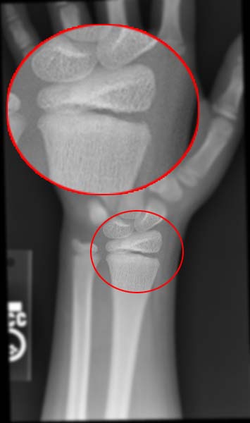 Salter-Harris fracture-I Image courtesy of RadsWiki and copylefted