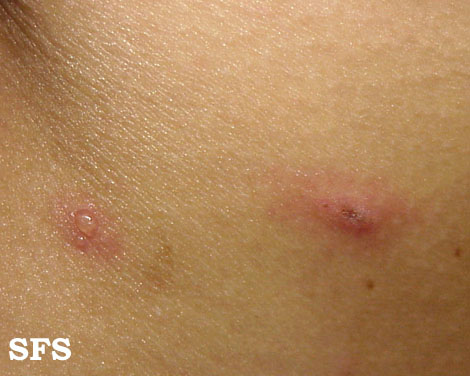 Varicella From Public Health Image Library (PHIL). [1]