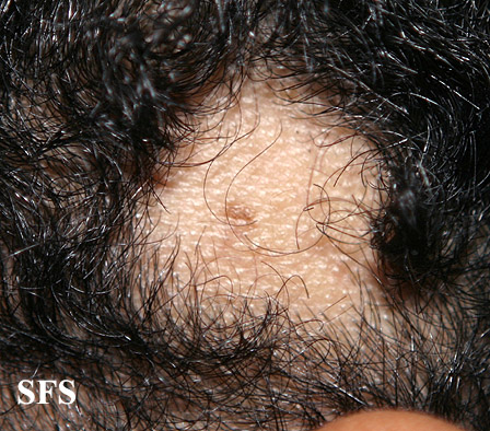 Alopecia acquisitum centrifugum. Adapted from Dermatology Atlas.[5]