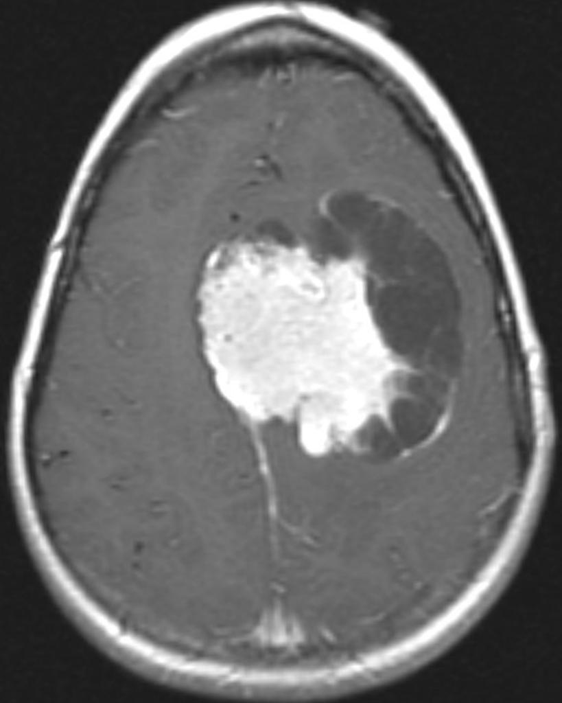 File:Cystic meningioma.jpg