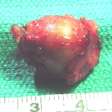 Post-auricular cyst specimen[4]