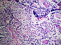Adrenal neuroblastoma[3]