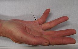 Dupuytren's contracture Source:Wikimedia commons