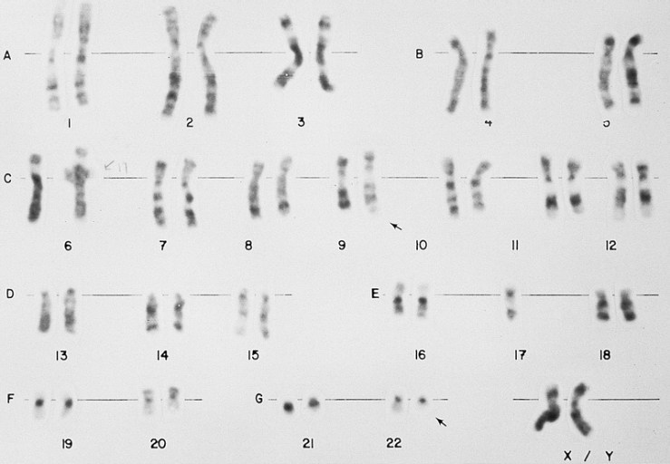 A t(9;22)(q34;q11) (Philadelphia chromosome) lymphoblast karyotype. This karyotype is from the bone marrow of a 28-year-old man with ALL. Material from the long arm (q) of chromosome 22 is translocated to the long arm of chromosome 9 (arrows). This translocation is found in approximately 20 to 25 percent of adults and approximately 2 percent of children with ALL. It is associated with a poor prognosis. (Giemsa-trypsin banding)