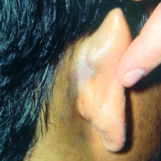 Battle's Sign. Bluish discoloration of the post-auricular region, associated with temporal bone fractures [4].
