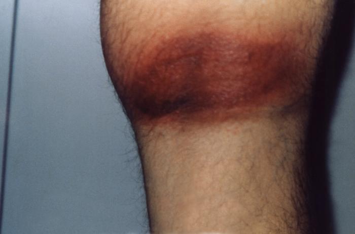 Posterior knee with the erythema migrans (EM) rash characteristic of what was diagnosed as Lyme disease, caused by the bacterium, Borrelia burgdorferi. From Public Health Image Library (PHIL). [1]