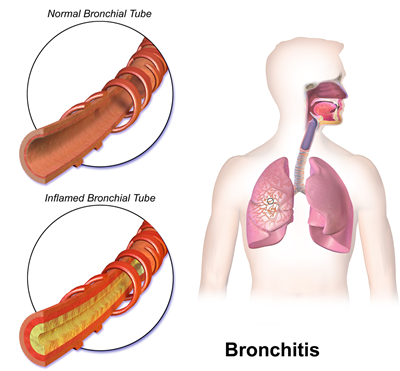 File:Bronchitis.png
