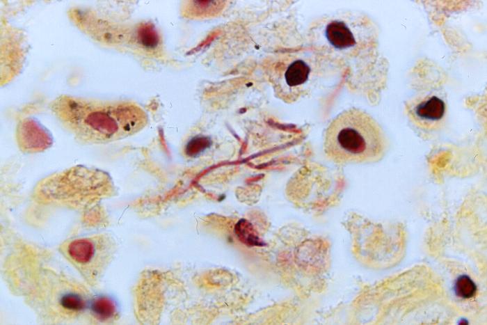 Lung tissue sample revealed the histopathologic changes indicative of fatal human plague (125x mag). From Public Health Image Library (PHIL). [18]