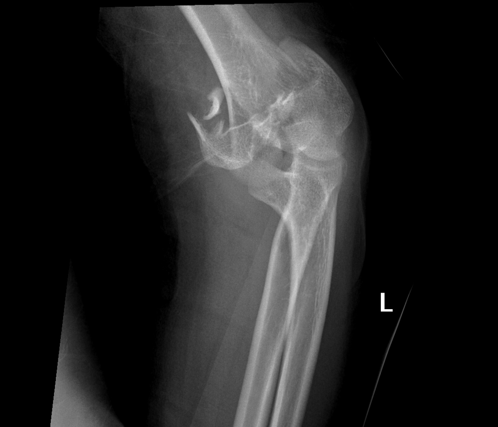 File:Displaced-t-condylar-and-supracondylar-fracture-of-the-distal-humerus.jpg