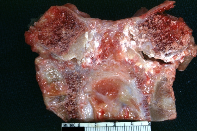 Bone, synovium: Gout: Gross natural color section through sternum and clavicle showing very well uric acid deposits in the periarticular tissue