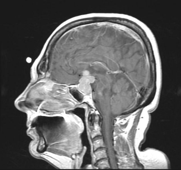There is a well defined homogeneously enhancing lesion in the pituitary fossa on Sagittal T1 C+ suggestive of pituitary adenoma.[7]