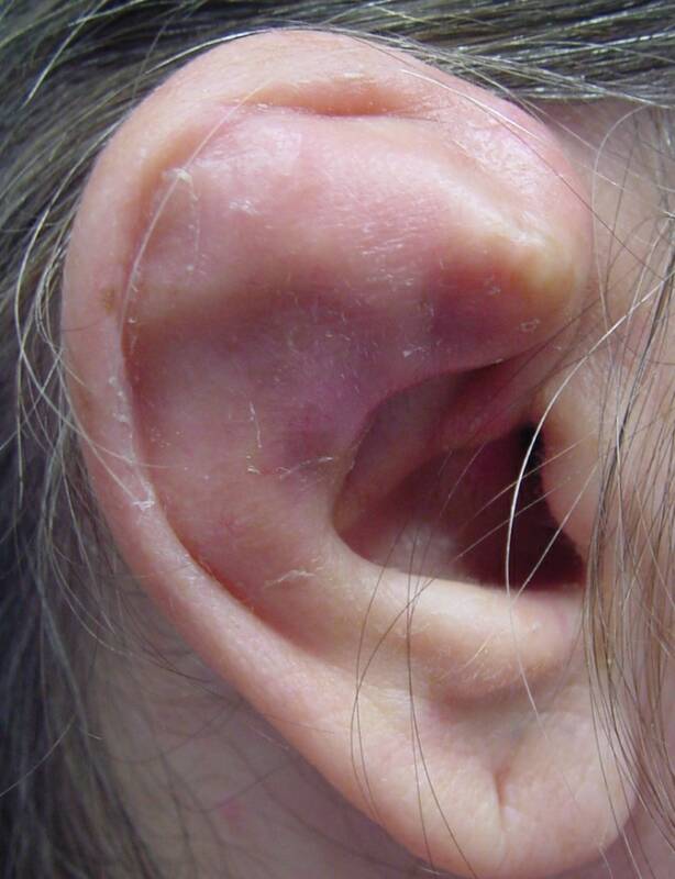 Chondroma of the auricle [1].
