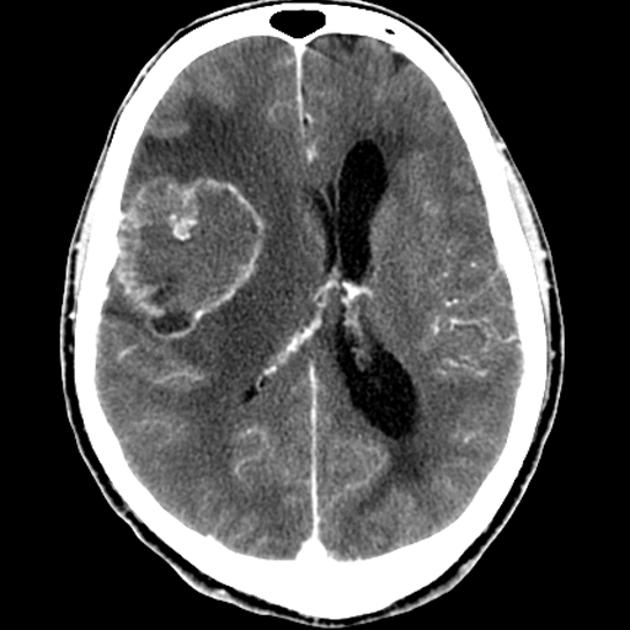 Postcontrast CT image of brain for a 60 year old male patient with metastatic bronchogenic carcinoma presenting with altered mental status and headache of recent onset demonstrating enhancing intra-axial lesion.[5]