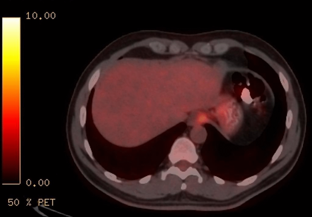 File:Pet CT gastric cancer.gif
