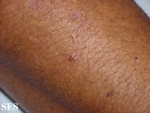 Porphyria cutanea tarda. Adapted from Dermatology Atlas.[2]