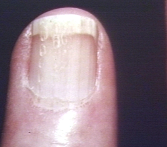 Hand: Scleroderma, finger, posterior nail fold