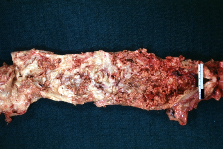 Atherosclerosis with Mural Thrombi: Gross, natural color, a nice photo of descending thoracic aorta with extensive ulcerated plaques and mural thrombi in distal portion. The case also has an abdominal aneurysm
