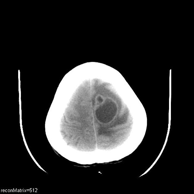 Noncontrast CT of a 36 year old female, a known case of esophageal cancer, presenting with headache and right sided hemiparesis, demonstrates a cystic lesion (37 x 31 mm) in the left high frontal lobe with significant perilesionalvasogenic edema causing mass effect in the form of sulcal effacement and subfalcine herniation.[7]
