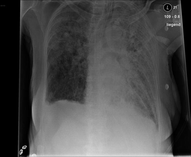 File:Candida pneumonia.jpg