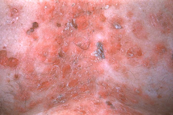 This patient presented with what was differentially diagnosed as a herpes zoster outbreak in order to rule out syphilis.