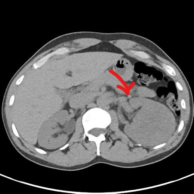 File:InkedAxial non-contrast CT of renal oncocytoma LI.jpg