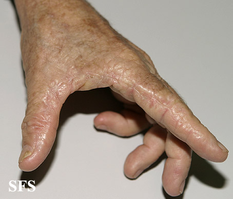 Marginal keratoderma of the palms. With permission from Dermatology Atlas.[1]