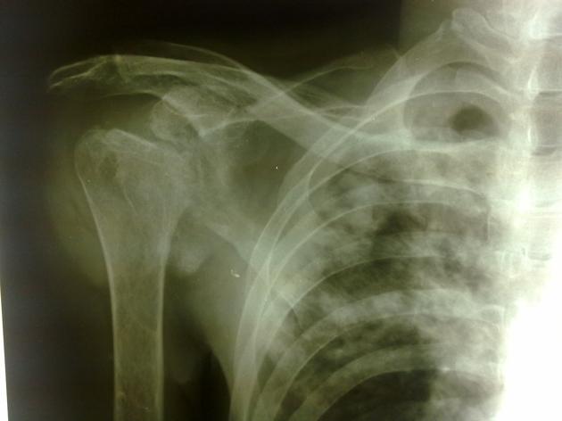 File:Shoulder Tuberculosis.jpg