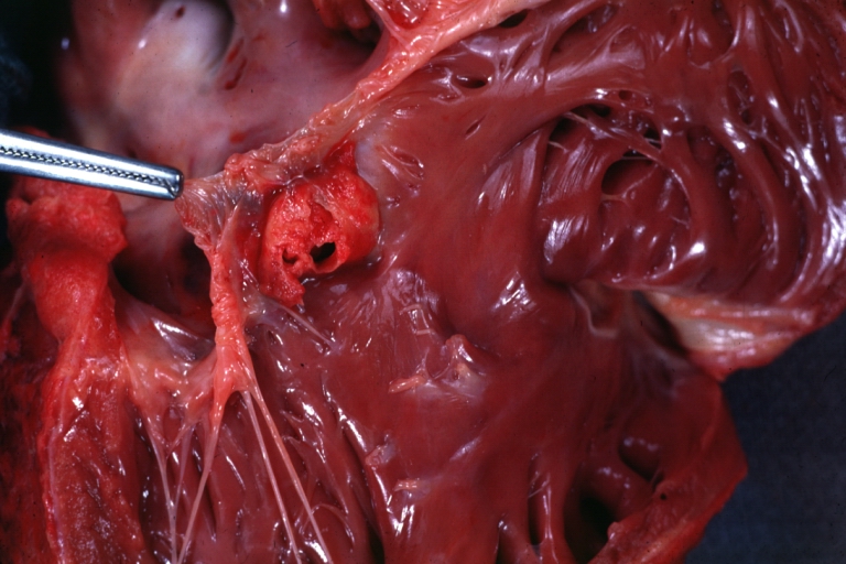 Sinus of Valsalva Aneurysm: Gross; a beautiful picture of windsock opening of aneurysm beneath anterior leaflet of tricuspid valve into right ventricle