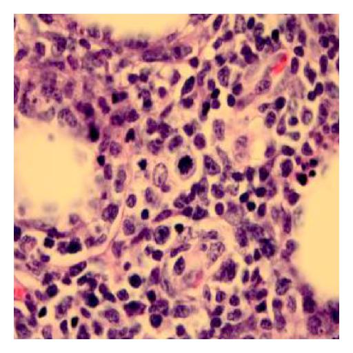 File:Subcutaneous panniculitis-like T-cell lymphoma biopsy 5.jpg