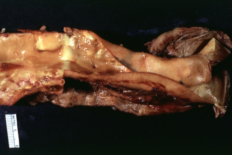 Dissecting Aneurysm in a patient with Marfan's syndrome