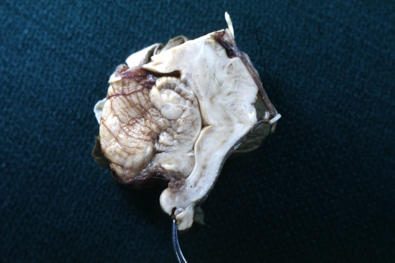 Brain: Arnold-Chiari Malformation: Gross fixed tissue sagittal section brain stem
