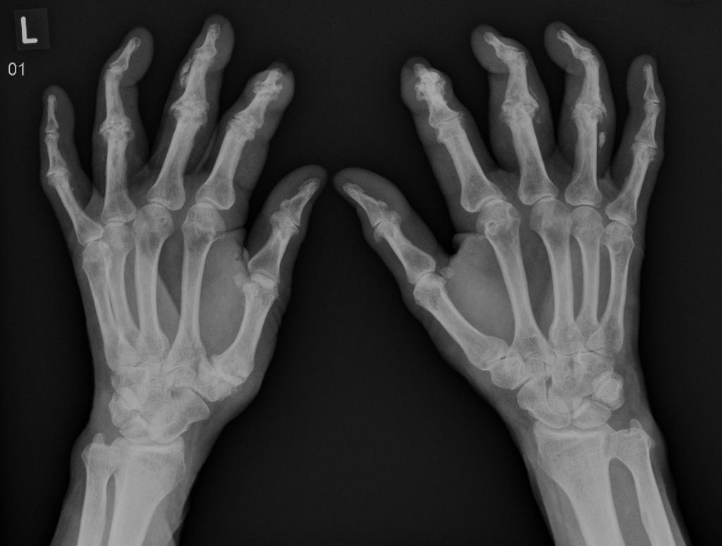 File:Mixed-connective-tissue-disease-1.jpg
