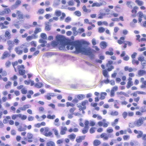 File:Paragonimus egg lung biopsy2.jpg
