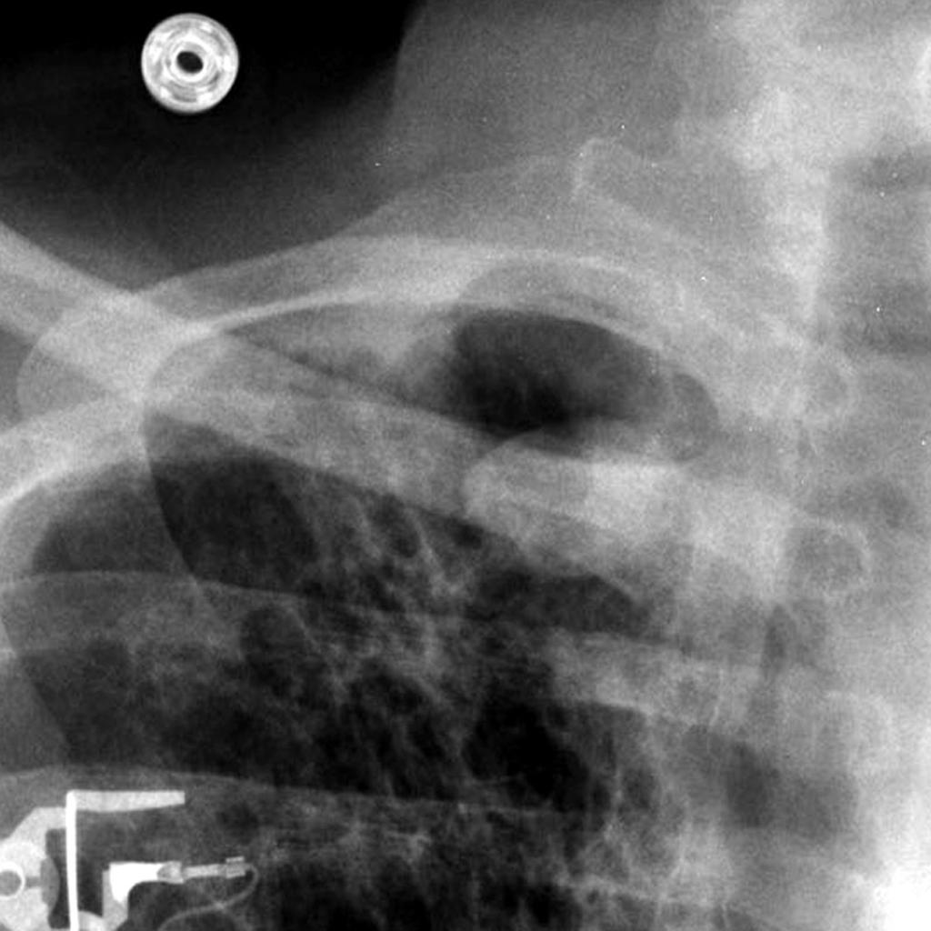A close up view on the patient demonstrates a well circumscribed, rounded opacity located at the medial aspect of the right lung apex