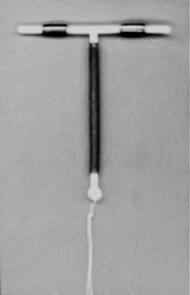 Photo of a common IUD (Paragard T 380A)