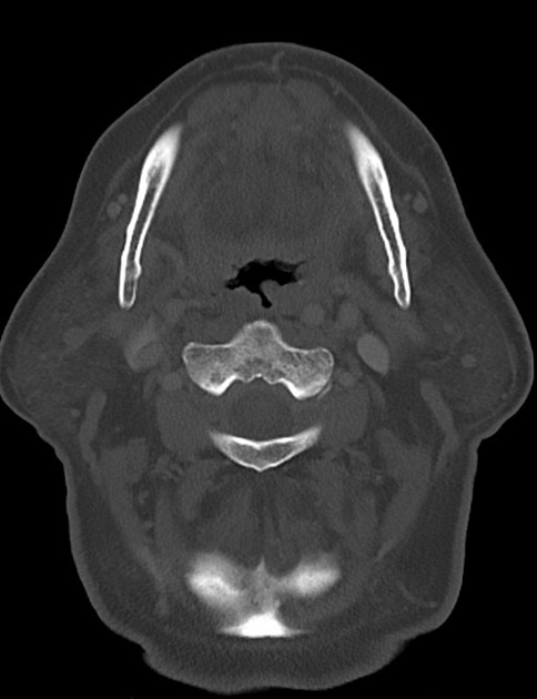 CT of squamous cell carcinoma of the tongue showing axial bone window [2]