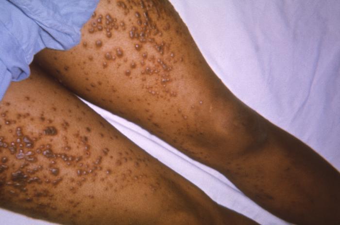 View of a patient’s thighs and upper legs, who’d been diagnosed with chickenpox. From Public Health Image Library (PHIL). [3]