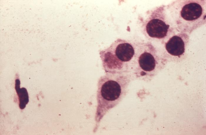 Photomicrograph of Chlamydia trachomatis taken from a urethral scrape. From Public Health Image Library (PHIL). [13]