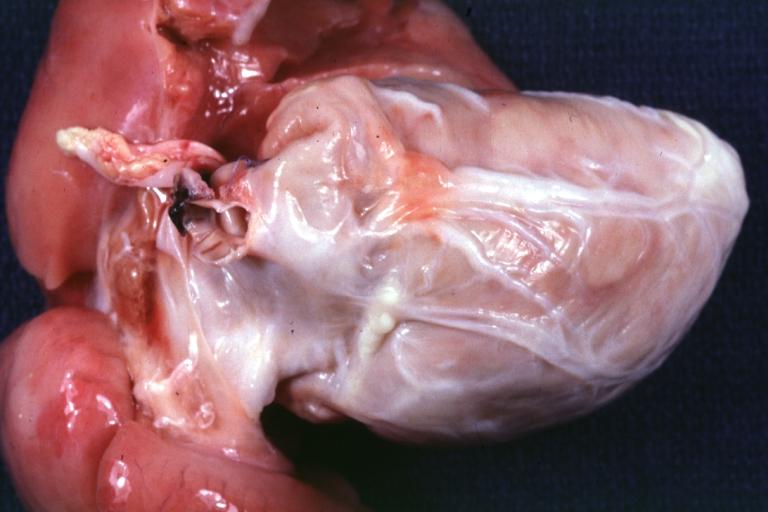 Coronary Artery Anomalous Origin Left from Pulmonary artery: Gross natural color anterior view of heart. Large marginal type coronary branches over anterior aspect of right ventricle.