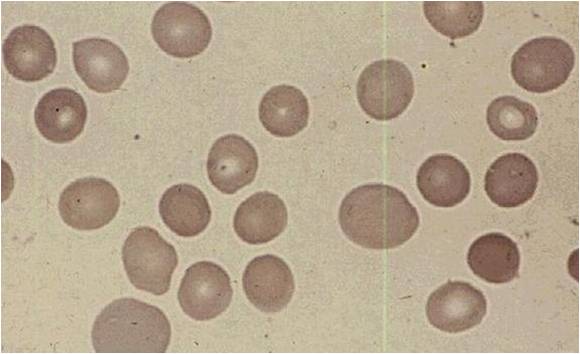 Peripheral blood in megaloblastic anemia