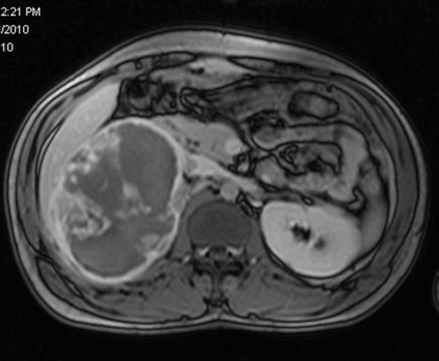 File:Pheochromocytoma MRI 04.JPG