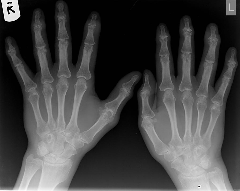 File:Psoriatic-arthritis of hands.jpg
