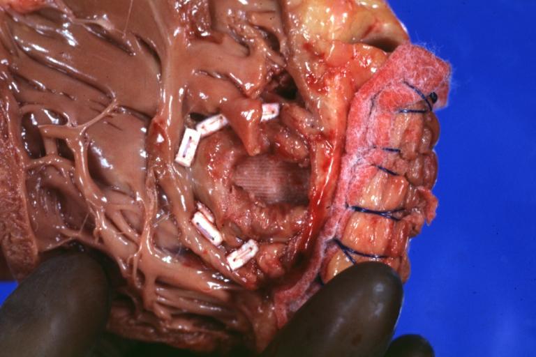 Gross natural color close-up of apical patch repair of ruptured infarct seen from right ventricle side septal rupture
