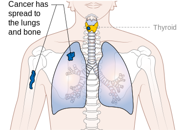 File:Stage M1 Thyroid cancer.png