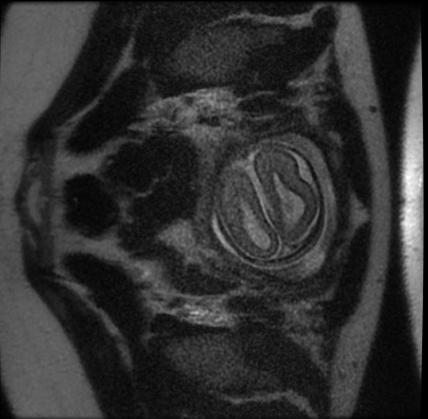 Fetal MRI: Agenesis of the corpus callosum