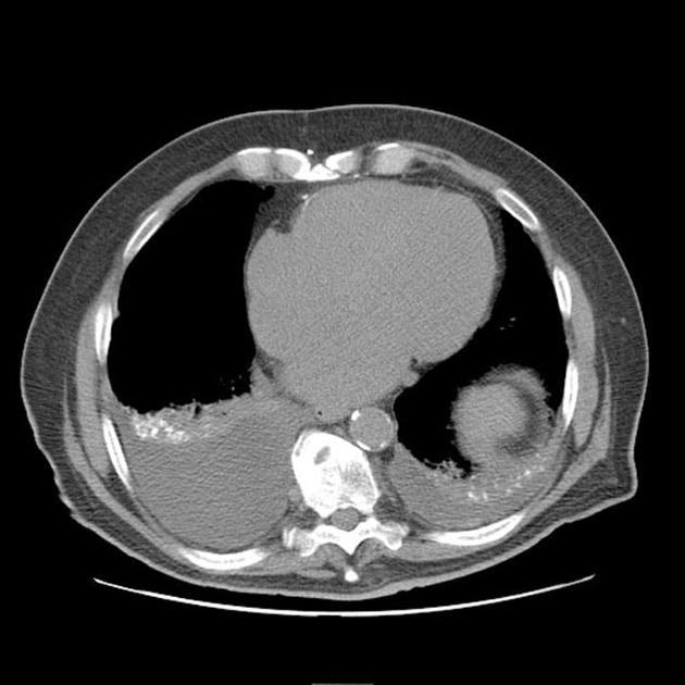 File:Axial CT aspiration 2.jpg