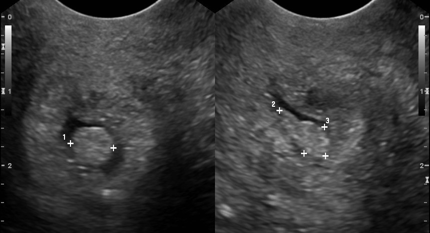 Image: Transverse ultrasound shows a cervical polyp characterized as a well-circumscribed mass within the endocervical canal.