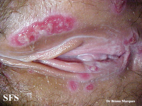 Chancroid. Adapted from Dermatology Atlas.[5]
